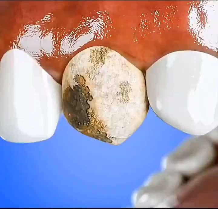 Gold tooth all day — a video by Frank on DeHub